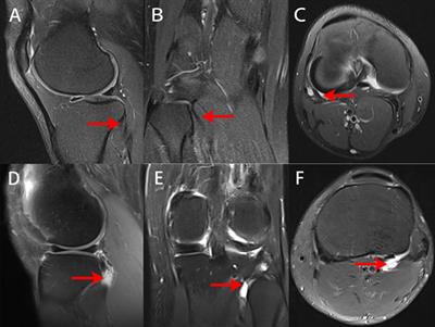 Arthroscopic Treatment of Popliteus Tendinitis Using the Accessory Portal